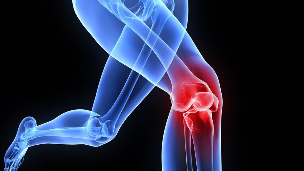 artroosist tingitud põlveprobleemid