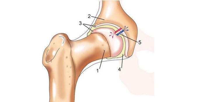 puusaliiges ja artroos
