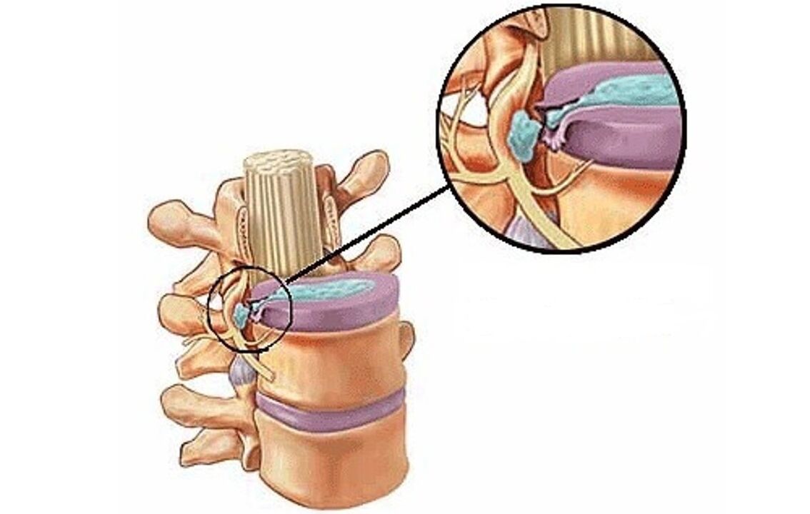 intervertebraalne song koos rindkere osteokondroosiga